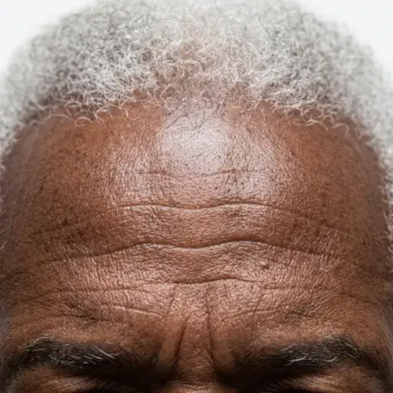 Wrinkles & Fine Lines